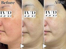 ラヴレボーテ(La Vraie Beaute)/40代・シミ 赤み・改善期間8ヶ月