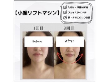 エスドット ビューティーサロン(S.beauty salon)の写真/リピート多数◎【即日小顔♪】お顔のたるみ・浮腫み・くすみにしっかりアプローチ。食いしばりケアにも。