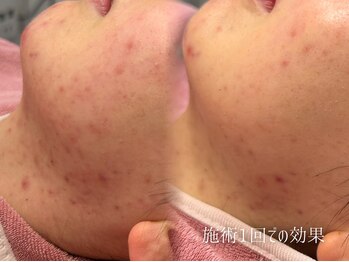 ピブ(pib.)の写真/何をしても変わらない、繰り返す肌悩みに。肌を見極め、あなたに合った肌質改善をご提案します◎