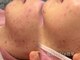 ピブ(pib.)の写真/何をしても変わらない、繰り返す肌悩みに。肌を見極め、あなたに合った肌質改善をご提案します◎