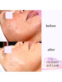 ココ センガ ビューティー クリニック(COCO SENGA Beauty-Clinic)/ジェットピールお手入れ後