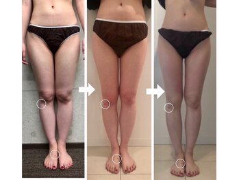 アンドモア(&more)/痩身症例