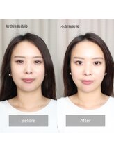 サンテ(Sante)/小顔施術前後