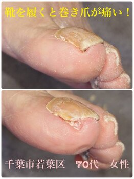 巻き爪じゅん 千葉駅前店/靴を履いて歩くと巻き爪が痛い！