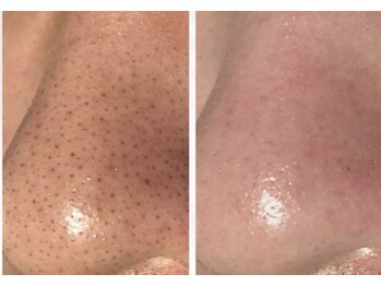 メディカルエース(MedicalAce)の写真/肌へ負担をかけず、気になる毛穴汚れをオフ！たるみ改善ハイサーマとのセットで"毛穴レスのちゅるん肌"へ♪