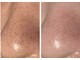 メディカルエース(MedicalAce)の写真/肌へ負担をかけず、気になる毛穴汚れをオフ！たるみ改善ハイサーマとのセットで"毛穴レスのちゅるん肌"へ♪