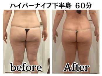 イデアルボーテ/はみ肉、セル脂肪撃退！