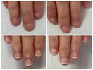 深爪矯正で理想の爪に♪