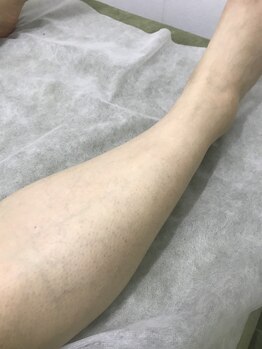 ナノハナ/栃木県鹿沼市全身脱毛のナノハナ