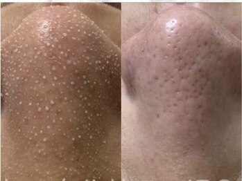 ヴィーヴ 京橋(vive)/【韓国式3D毛穴洗浄】