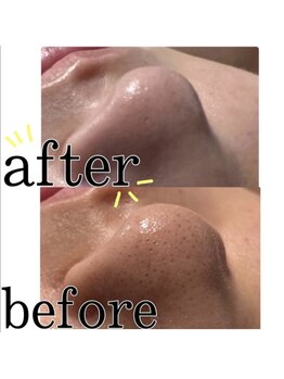 サロンチョコ(salon choco)/毛穴フェイシャル