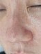 ケイビューティーセンター(K beauty center)の写真/【本気の毛穴改善】毛穴に悩む方必見！毛穴に特化したコースあり◎あなたのお悩みを解決します！