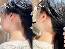 ピミル(PIMIL)/うなじ脱毛