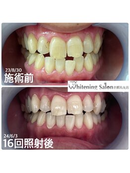ホワイトニングサロン 京都烏丸店/ホワイトニング施術例