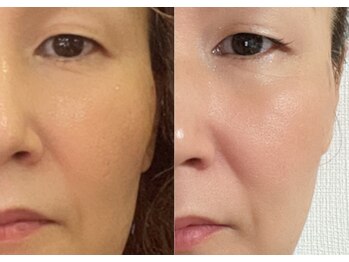 MBR 群馬店/小顔になりたい方☆ピソンヘッド