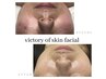 victory of skin facial