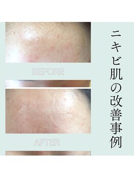 石井クリニック美容研究所エステティク 熊本サロン/ニキビ肌改善事例