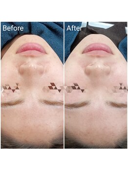 レン(Ren)/ラテスパ〈毛穴ケア/美白/ツヤ〉