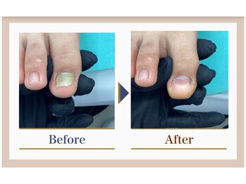 巻き爪補正店 錦糸町店/【変形爪再生補正】
