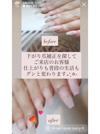 下がり爪の方、お任せください！