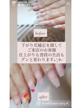 下がり爪の方、お任せください！