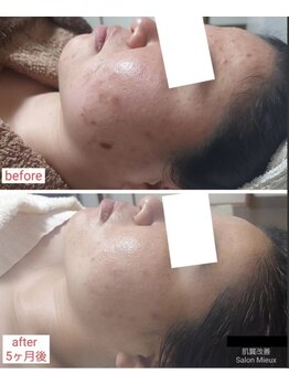 ミュー(Mieux)/ビックリ！シミ化した跡も激変！