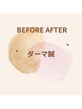 マホロバ(mahoroba)/ダーマ鍼＋美容鍼＋幹細胞導入