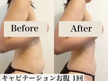 アトレセカンドボディ(Attrait second body)/Before→After【1回目】