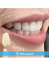 ホワイトニングカフェ 郡山店/＊ホワイトニング症例写真＊