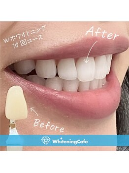 ホワイトニングカフェ 郡山店/*ホワイトニング症例写真*