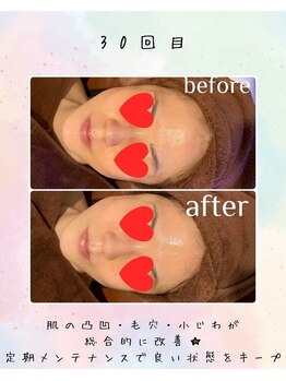 リリアン(lirien)/毛穴/毛穴ケア/毛穴洗浄/駒込