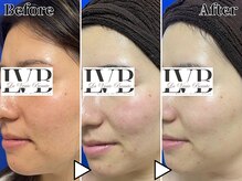 ラヴレボーテ(La Vraie Beaute)/20代・にきび・改善期間8ヶ月