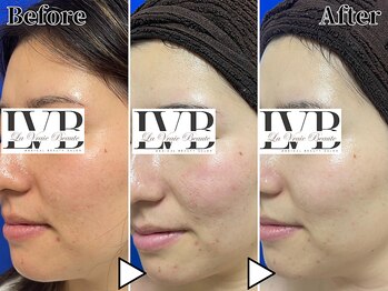 ラヴレボーテ(La Vraie Beaute)/20代・にきび・改善期間8ヶ月