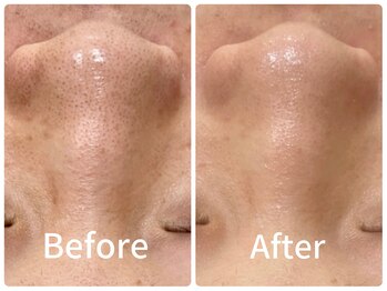 ジョアアンジェ 京橋店(joie ange)/脱いちご鼻！！ちゅるん肌