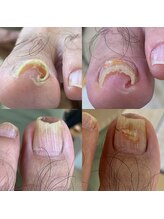 ニコ(niko)/巻き爪矯正　20分で改善