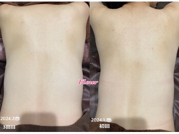 フルール(Fleur)/■背中トリートメント■