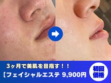 メンズビューティサロン ブレス(bless)
