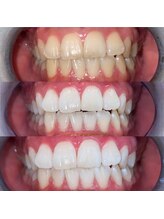 ホワイトニングビューティ 三川店/驚く効果！