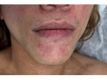 星空脱毛/肌が弱い方でもお任せ下さい！