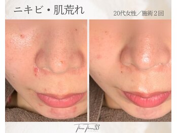 スリースリー(THREE THREE)/ニキビ・肌荒れケア