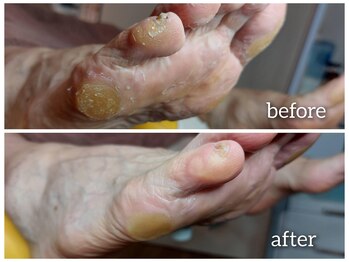 爪切り屋 足楽/【タコ・魚の目】基本の角質ケア