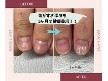 ブルームブルーム(BLOOMブルーム)/ついつい切りすきて深爪