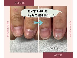 ついつい切りすきて深爪