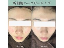 メロサロン 武蔵浦和店(Melo Salon)の雰囲気(大人気メニュー★ヒト幹細胞×ハーブピーリング+ヘッドスパ)