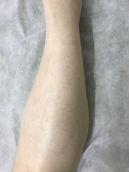 ナノハナ/鹿沼市の全身脱毛のナノハナ