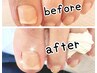 新しい技術！巻き爪矯正（1本）クリアまたはマット仕上げ　¥5000