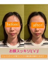 ラクリエ 姫路駅前院(La Creer)/小顔矯正ビフォーアフター
