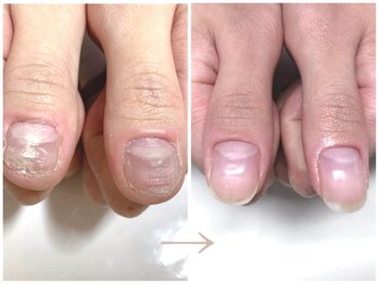 インブロッサム(imblossom)/深爪矯正/自爪育成