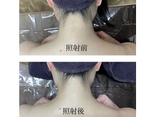 ホッコリ 府中店(HOKKORI)/【男女OK！】痛みの少ない脱毛