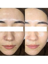 アーネスト 大阪心斎橋店(EARNEST)/水光ピーリング【 ニキビ・跡 】